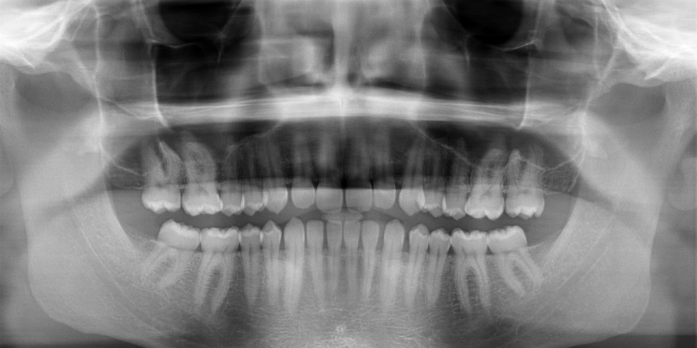 Orthopantomogram (OPG)